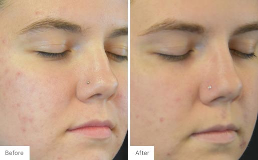 9 - Before and After Real Results photo of a woman's use of Neora's Acne Complexion Treatment Pads