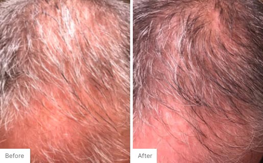 8 - Before and After Real Results picture of a man's scalp.